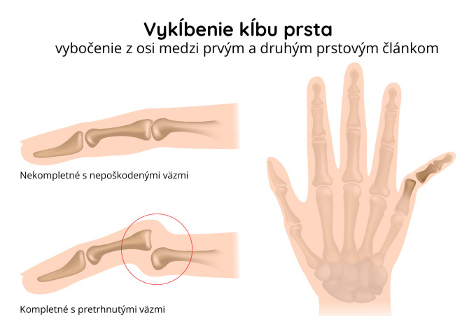 Vymknutie kĺbu prsta ruky 