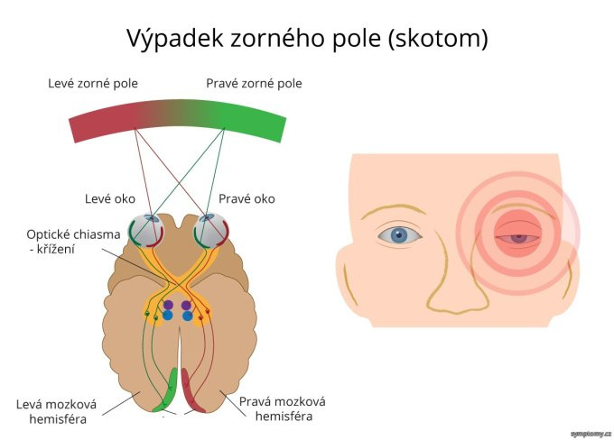 Výpadok zorného poľa