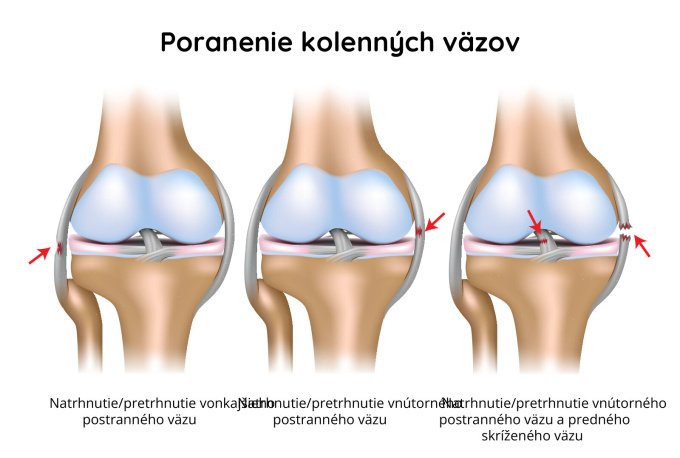 Vyvrtnutie, podvrtnutie kolena