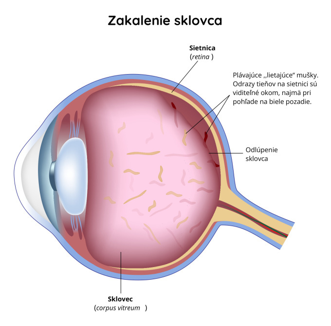 Zakalenie sklovca