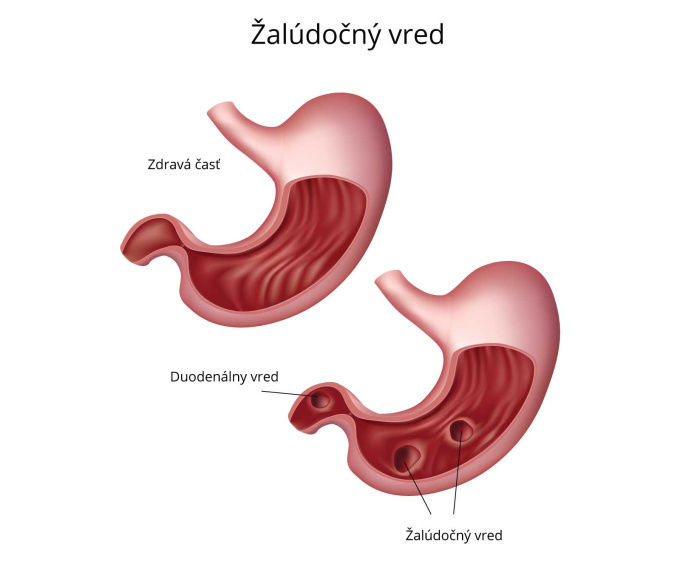 Žalúdočný vred