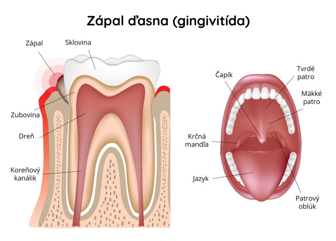 Zápal ďasná