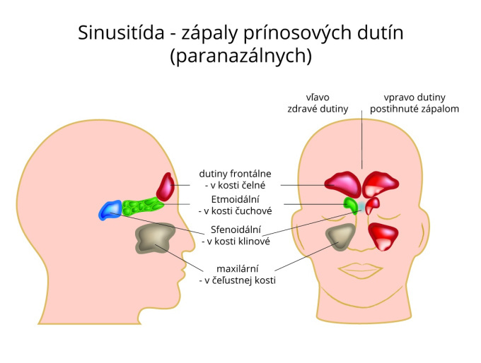 Sinusitida-zápaly prínosových dutín