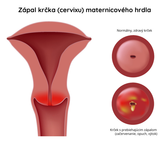 Zápal krčka maternice 