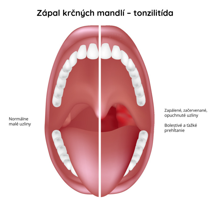 Zápal krčných mandlí – Tonzilitída 