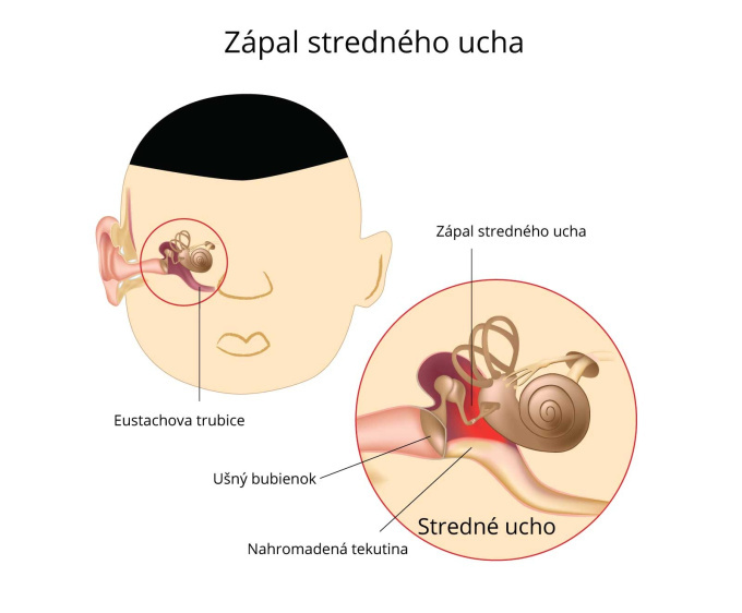 Zápal stredného ucha