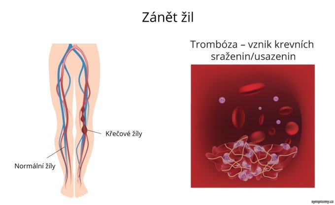 Zápal žíl
