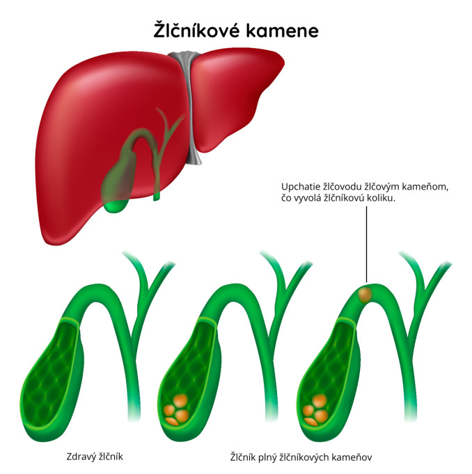 Žlčníkové kamene 