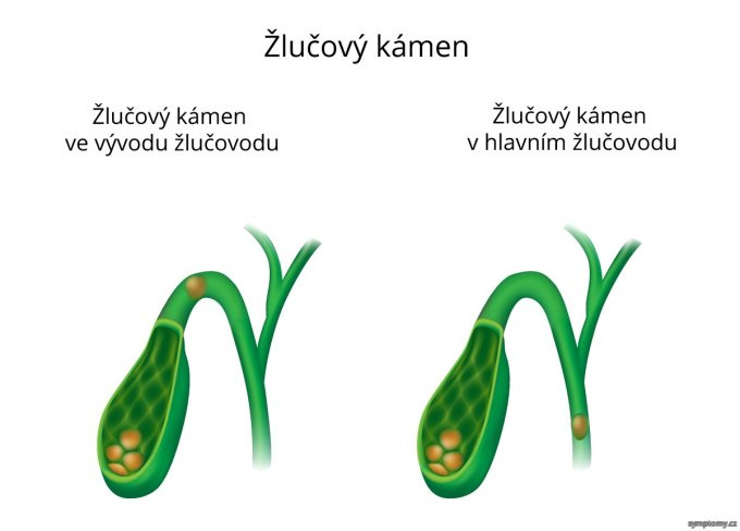 Žlčníkový záchvat
