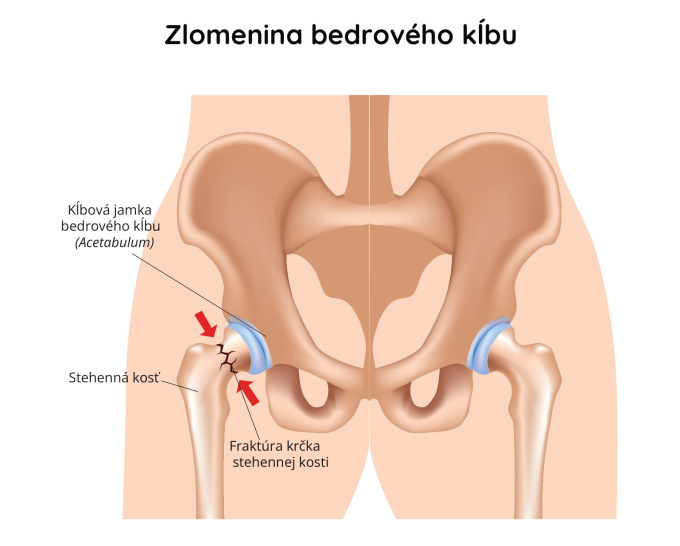 Zlomenina bedrového kĺbu