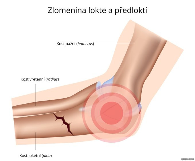 Zlomenina lakťa a predlaktia
