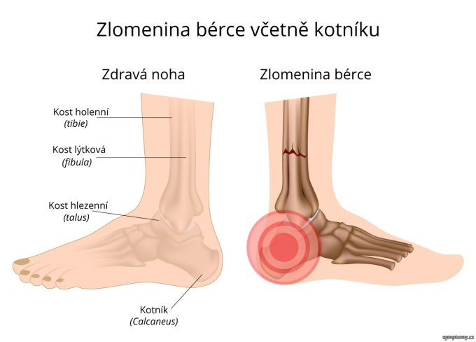 Zlomenina predkolenia vrátane členku