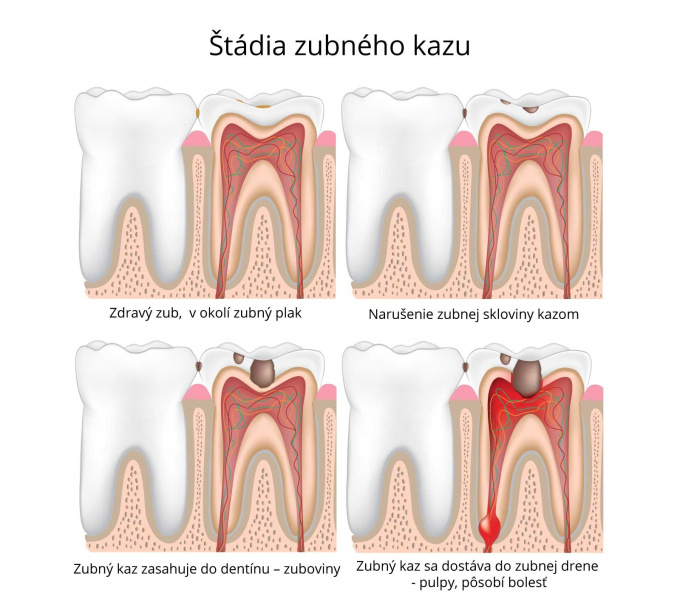 Štádia zubného kazu