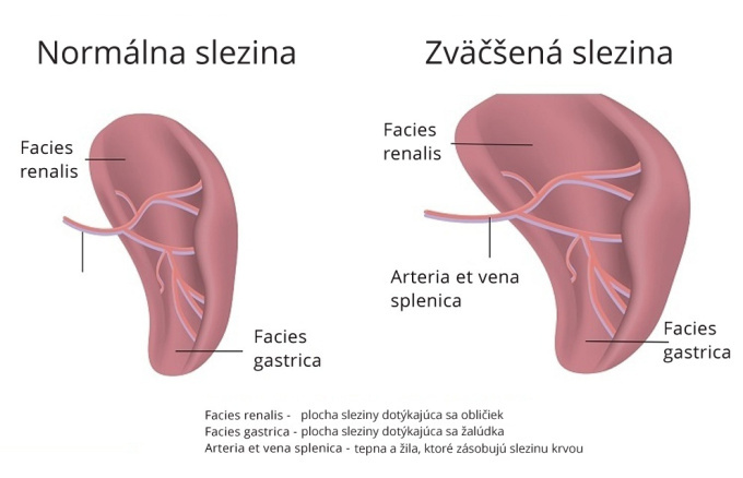 Splenomegalie-zväčšená slezina