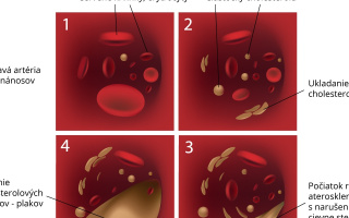 Štádia rozvoja aterosklerózy kôrnatenie tepien