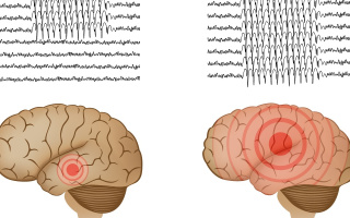 Epilepsie - grafoelementy 