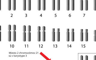 Downův syndrom- Trizomia chromozómu 21