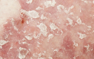 Psoriasis vulgaris