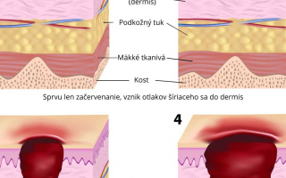 Štádia poškodenia pri nadmernom či dlhodobom tlaku