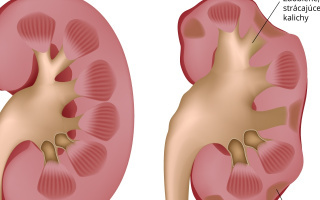 Zápal obličiek - chronická pyelonefritida