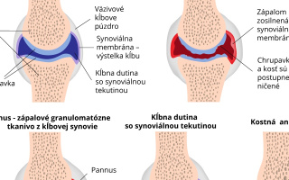 Štádia reumatoidnej artritídy