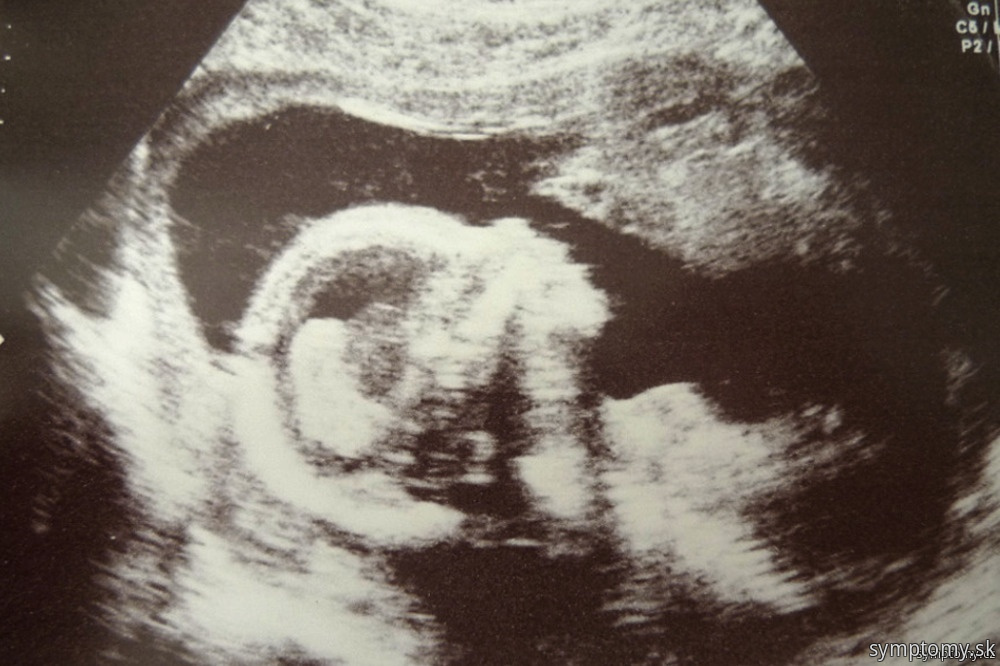 Ultrazvuk - piaty mesiac tehotenstva