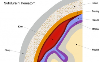 Hematóm