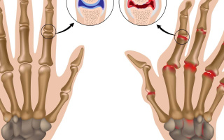 Reumatoidná artritída prstových kĺbov