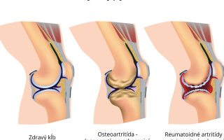 Rozdiely medzi osteoartritídou a reumatickou artritídou