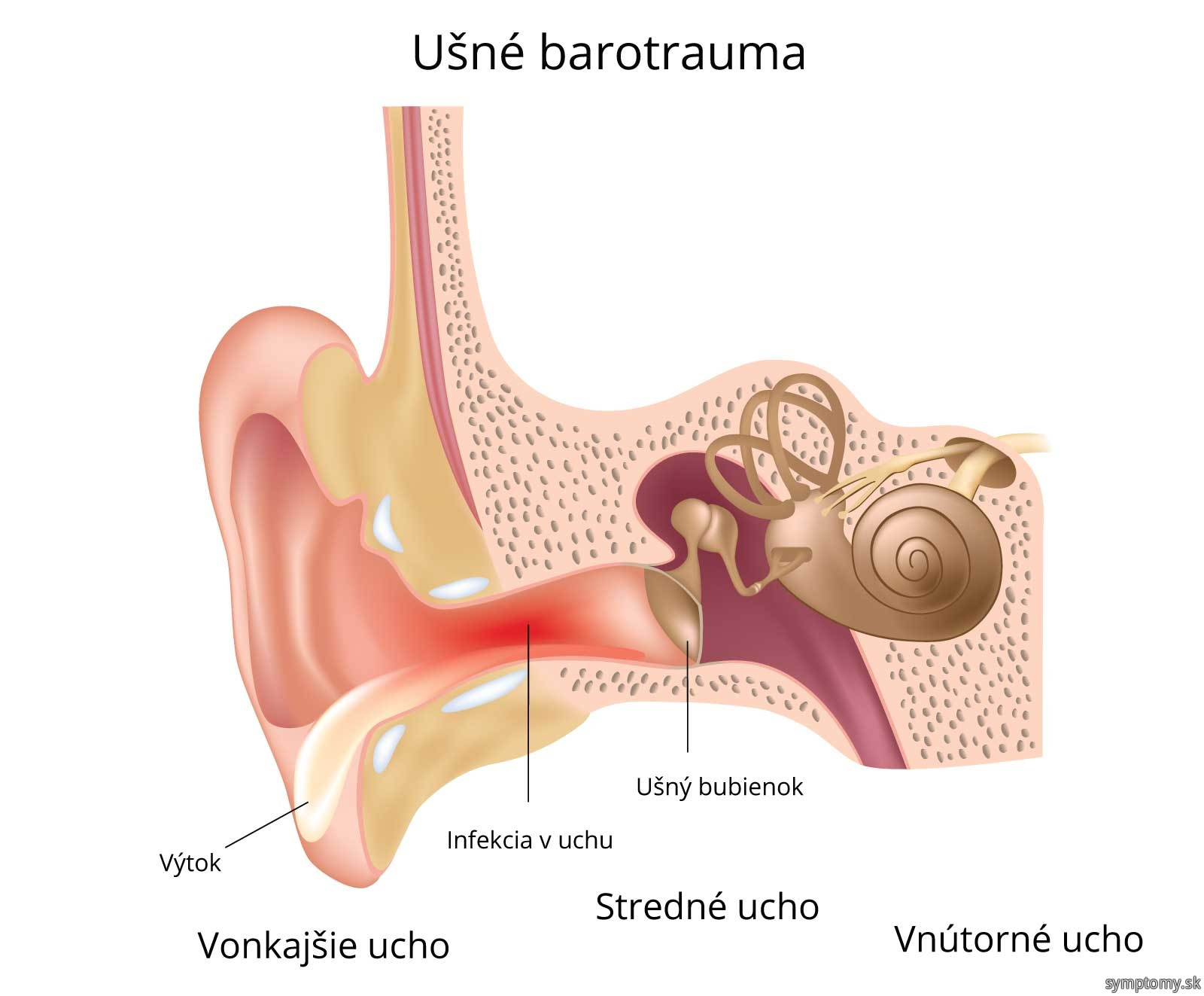 Ušné barotrauma