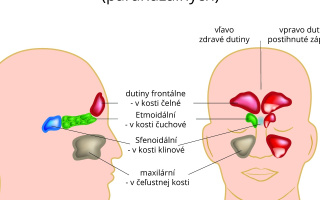 Zápal dutín