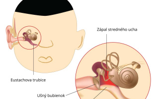 Zápal stredného ucha