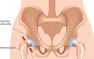 Zlomenina bedrového kĺbu
