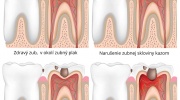 Zubný kaz